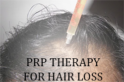Webster family care PRP THERAPY FOR HAIR LOSS treatment